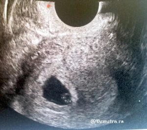 ultrazvuk 6. nedelja trudnoce