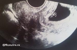 ultrazvuk 7. nedelja trudnoce 