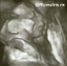 ultrazvuk u 20. nedelji trudnoće