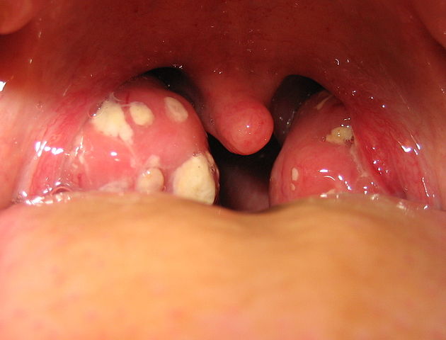 Tonzilitis angina