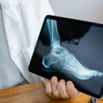 Sprečite osteoporozu hranom