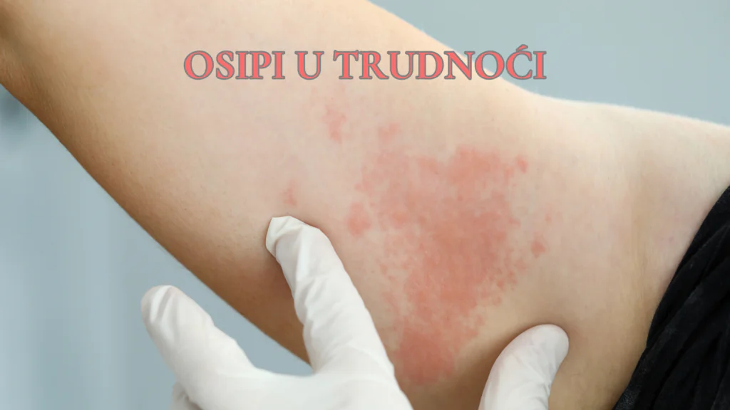 osipi u trudnoci
