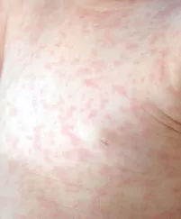 roseola - trodnevna groznica