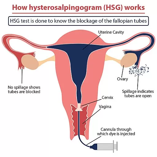 hsg