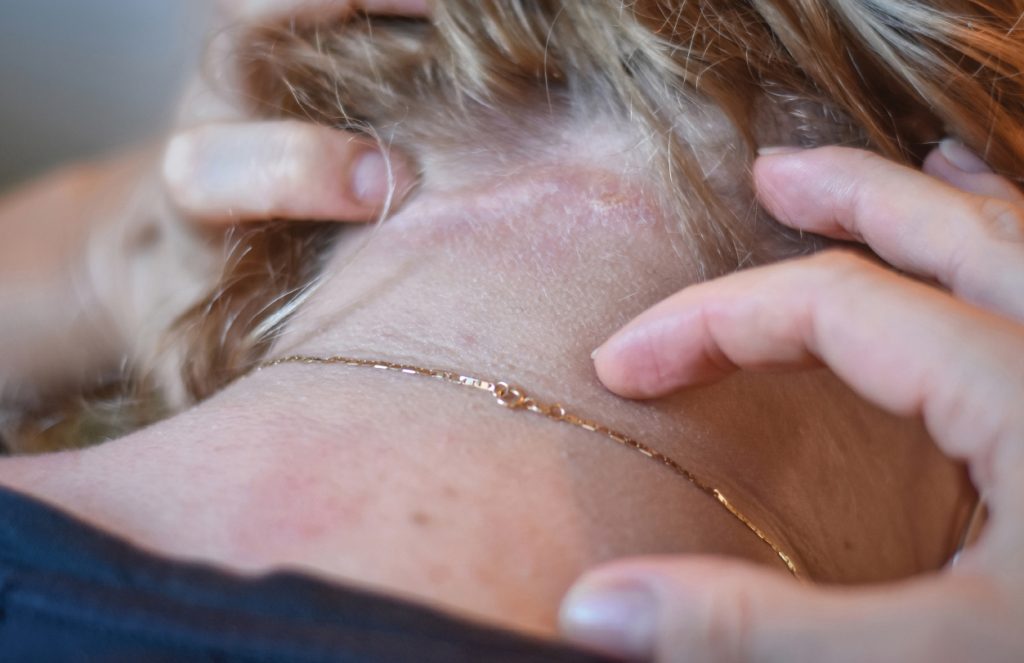 Svetski dan atopijskog dermatitisa 