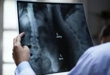Prelom kostiju zbog osteoporoze